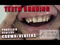 Veneercrown teeth shaving  a1 smile design  p6