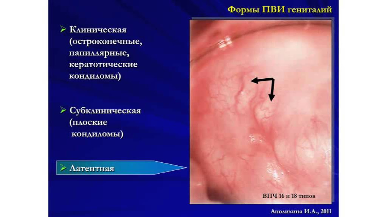 Как вылечиться от папиллом
