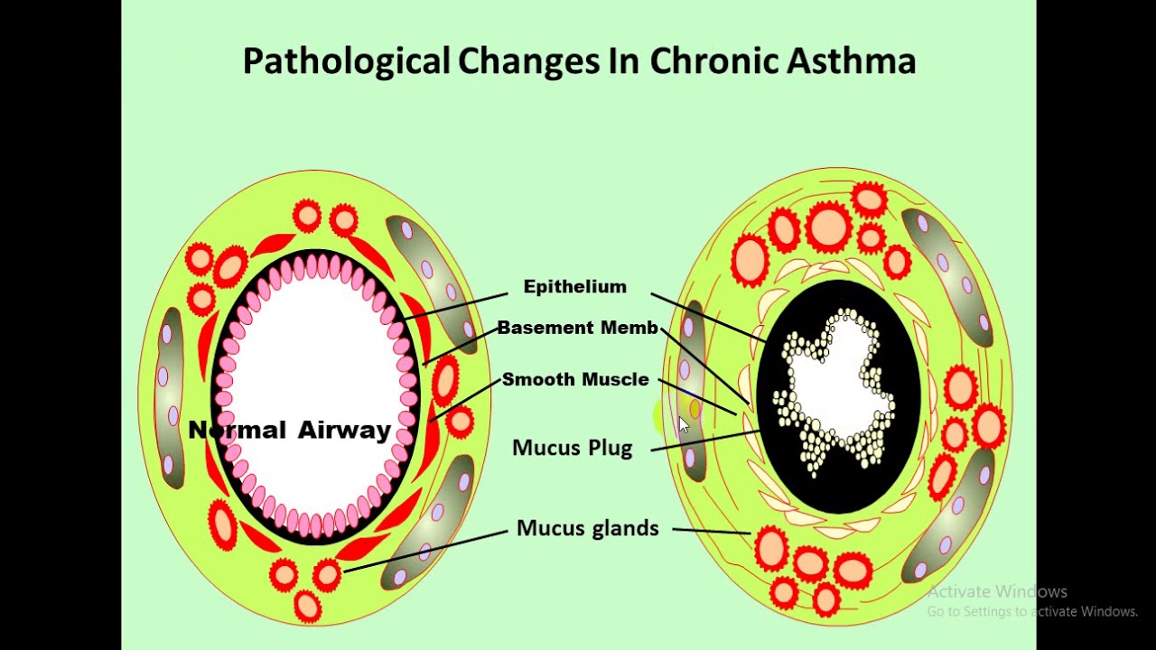 general medicine Asthma YouTube
