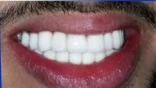 تبييض الأسنان في ثواني قسما بالله تزيل الإصفرار و تسقط الجير بعد فرك أسنانك بها مجربة و مضمونة 100%