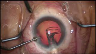 Cataract extraction &amp; intraocular lens (IOL) implant #iol #cataract #surgery #implant #Intraocular