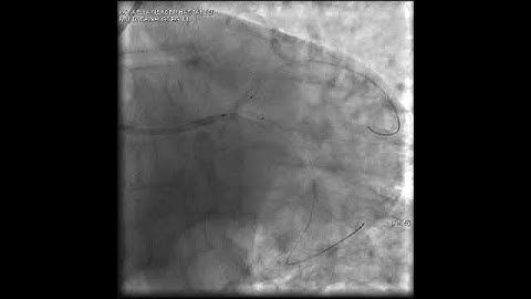Complex PCI for LCX ostial lesion video 10
