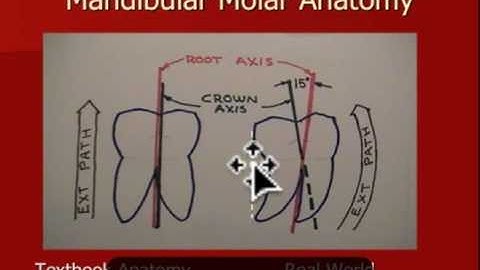 Oral Surgery Hints - Impaction Extraction