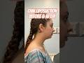 Mariah S Chin Lipo Results Double Chin Gone At Adonis Plastic Surgery Torrance CA 
