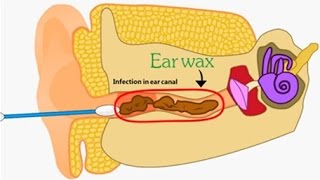 Putting Q-Tips In Your Ears Is VERY Bad For Your Health, And Here's Why