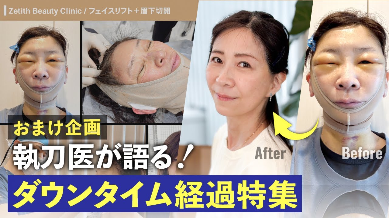 Downtime] A Detailed Look at Facelift Recovery After One Year