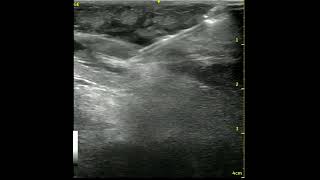 POCUS Video 8