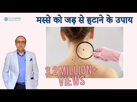 वीडियो: बच्चों में मौसा का इलाज कैसे करें