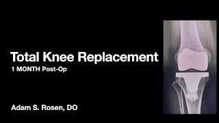 One Month PostOp Total Knee Replacement  Expectations, common findings and physical therapy