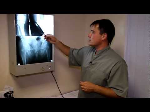 Видео: Артроз коленного рентгена