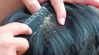 ASMR Scalp Care and Scratching Sounds for Better Sleep #1102