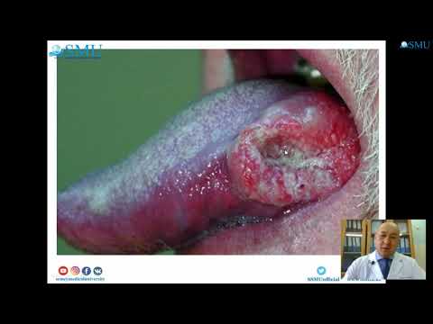Предраковые заболевания слизистой оболочки полости рта и языка
