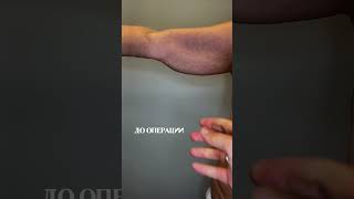 Брахиопластика.