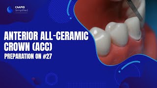 Anterior AllCeramic Crown (ACC) Preparation on #27 | Caapid Simplified Bench Prep Course