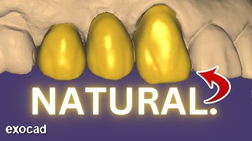 EXOCAD: Bridge Tutorial 2025