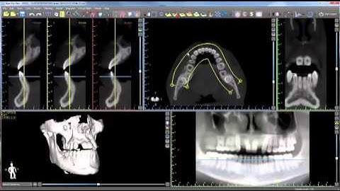 BSP Step by Step Process: Panoramic Curve