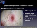 Dermoscopy of cutaneous lymphomas   dr enzo errichetti
