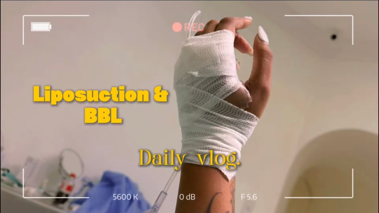 BBL & 360 liposuction Surgery 