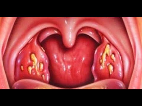 Acupuntura y amigdalitis | Doovi