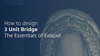 How to Design a 3 Unit Bridge in Exocad - Part 1 | Essentials of Exocad