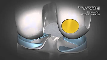 Comment soigner une fracture du cartilage ?