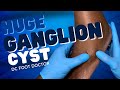 Huge Ganglion Cyst