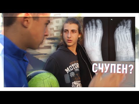 Видео: Счупен пръст на крака