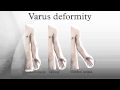 Cubitus varus surgery(elbow varus deformity) - YouTube
