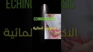 الاكياس المائية  | ماهي | وماهي خطورتها | echinococcosis