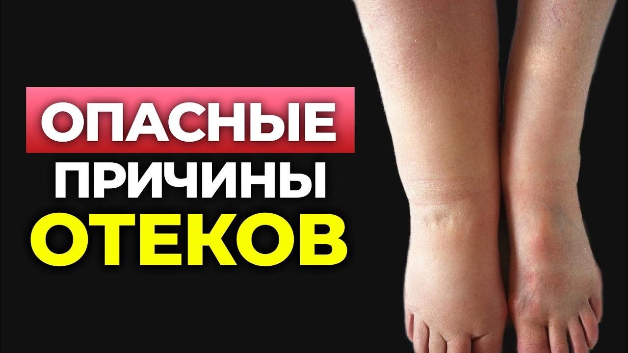 Как ИЗБАВИТЬСЯ ОТ ОТЁКОВ? Причины появления и проверенные методы ...