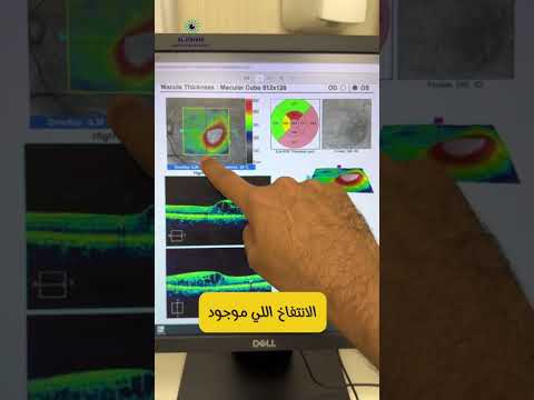 هل حقن العين مفيدة