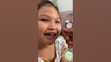 Cận cảnh nhổ răng bằng chỉ cho chị hai Bella