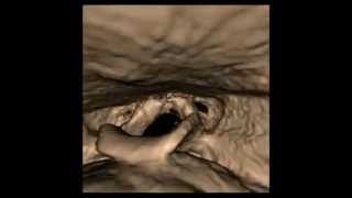 3D Module: Virtual Endoscopy