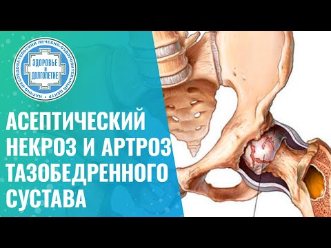 👉 Асептический некроз головки бедренной кости и артроз тазобедренного сустава