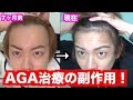 【ハゲ日記】AGA薄毛治療8ヶ月目！