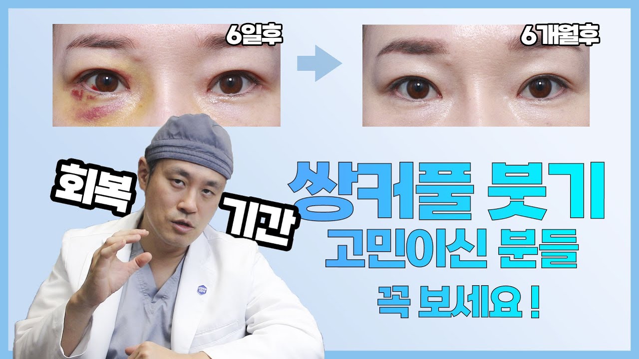 쌍커풀 수술 붓기 빠지는데 6개월-1년 얼마나 걸리나요? #쌍커풀수술 #일상회복 #쌍수후기 - YouTube