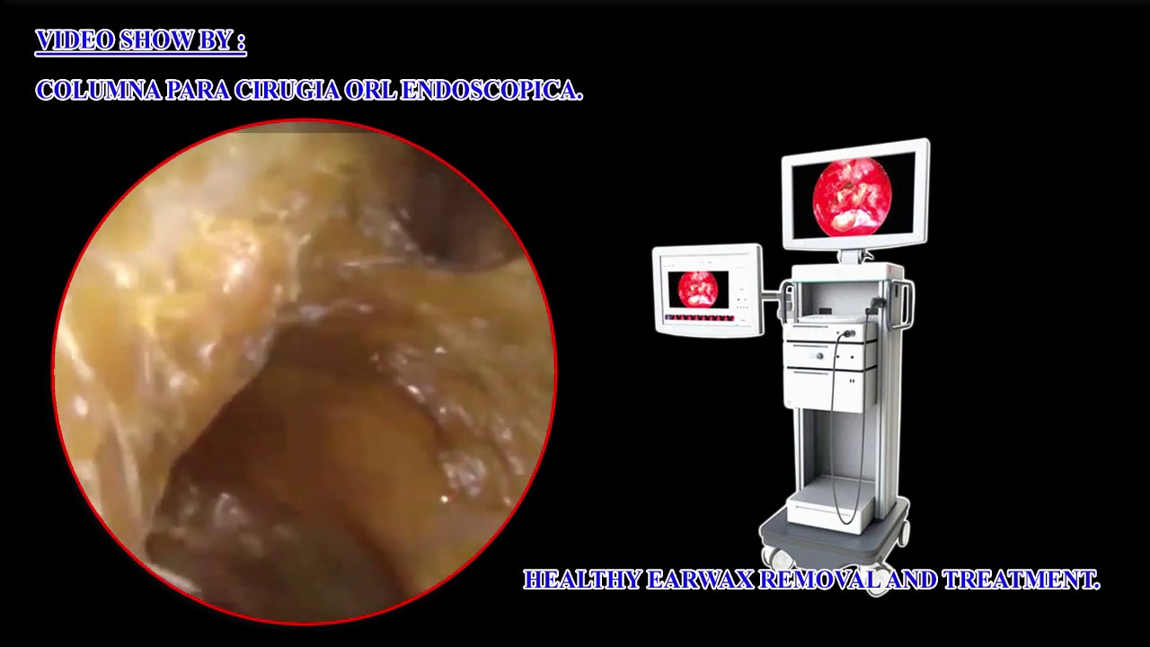 HOW DO YOU KNOW IF YOU HAVE EAR WAX | Ms_Rothangelai - YouTube