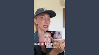 Antes y después de mi Blefaroplastia y Lifting Facial