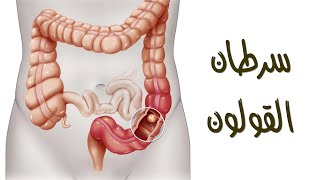 أورام القولون | الأسباب وطرق العلاج