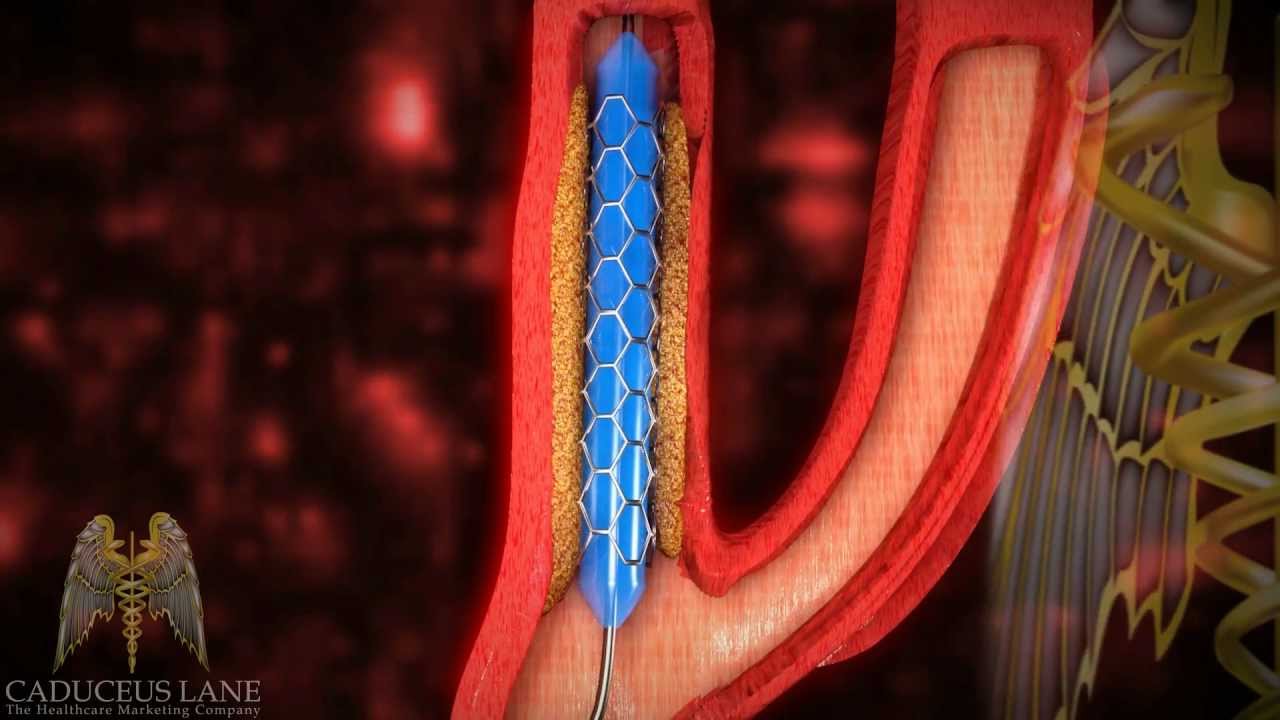 3d Medical Video Hd Carotid Artery Stenting Youtube