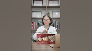lấy cao răng là gì? có 2 phương pháp lấy cao răng #shorts #teeth