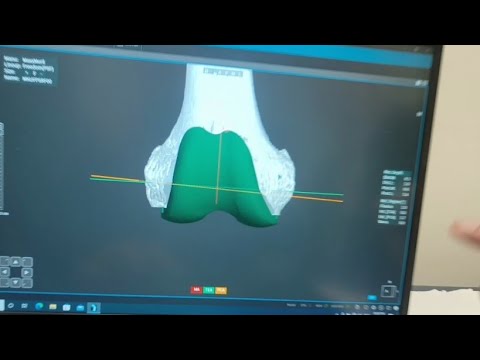 Implant planning for Robotic Knee Replacement