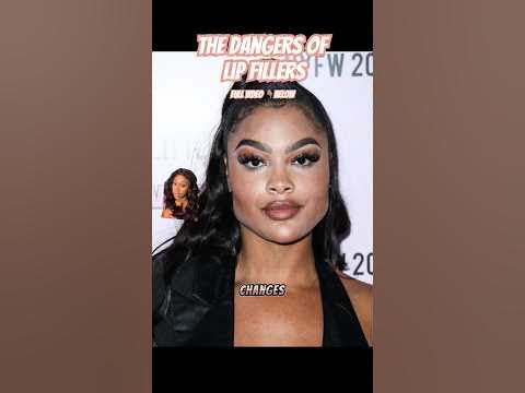 Everyone’s getting lip filler BUT this is What they aren’t telling you
