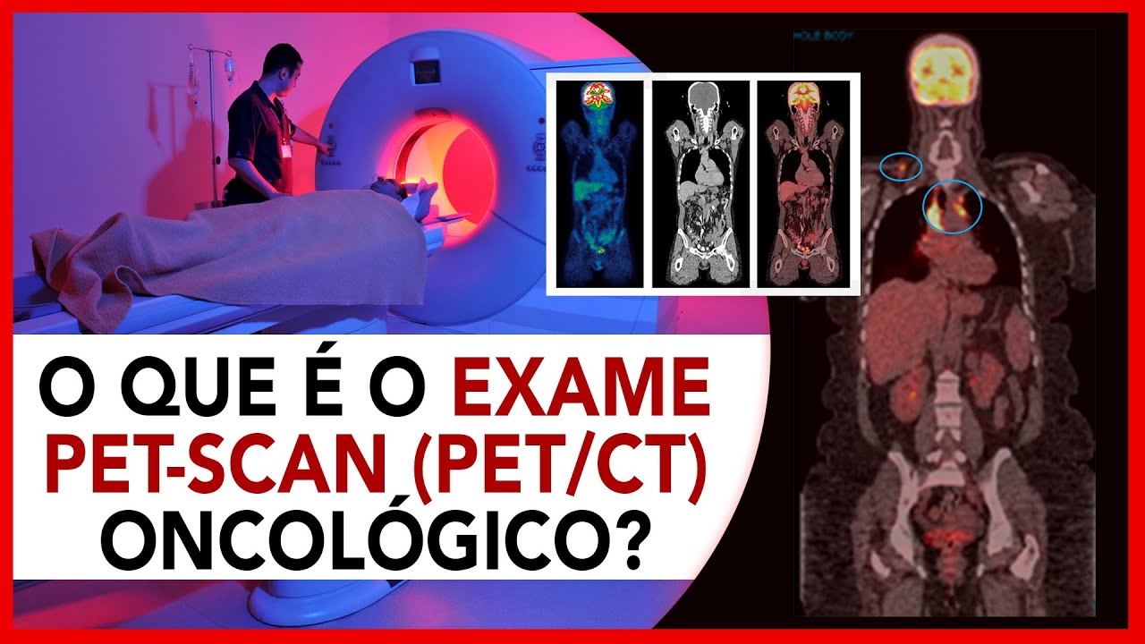 O que é o Exame Pet CT oncológico? - YouTube