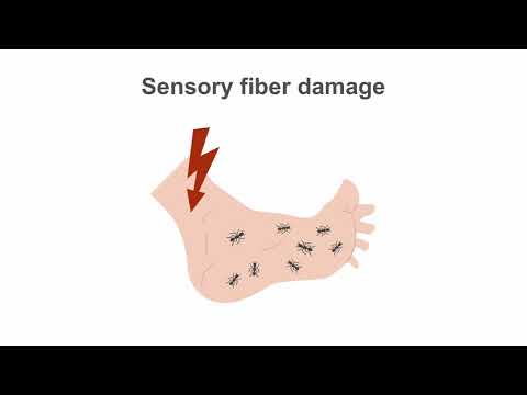 Video: Leg Pain In Diabetes Mellitus - Signs, Causes And Complications Of Leg Pain In Diabetes Mellitus