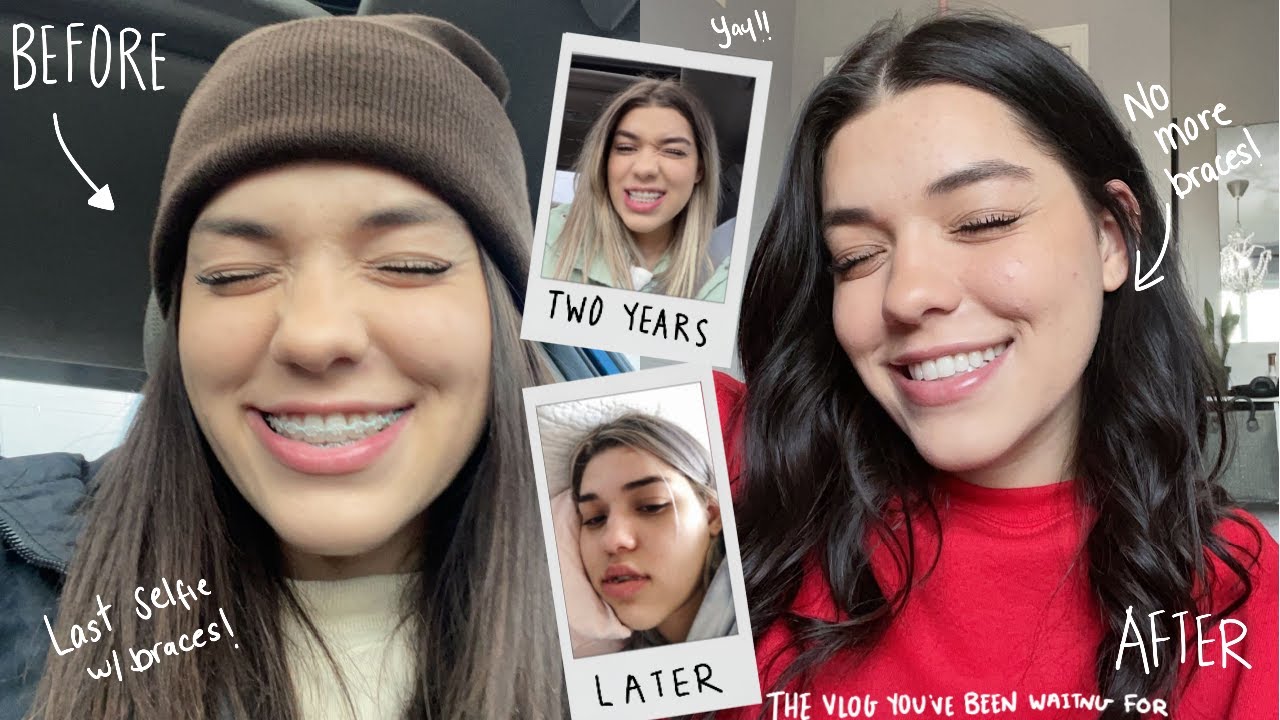 I GOT MY BRACES OFF! - before & after, experience + friends reactions!