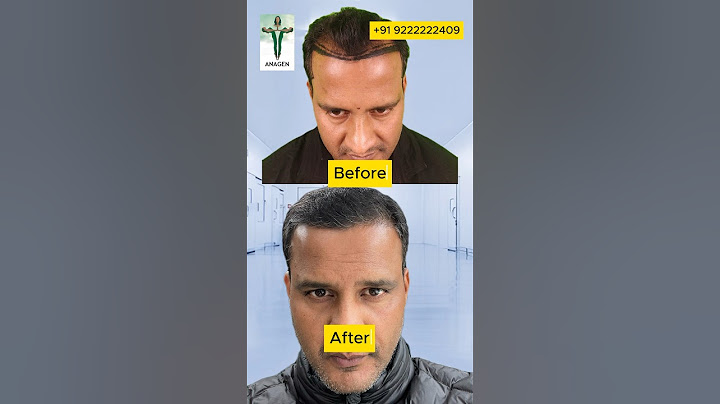 4 Months Hair Transplant Results