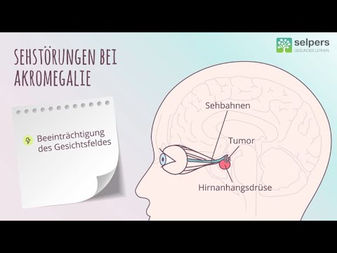 Video: 3 Möglichkeiten zur Diagnose von Akromegalie