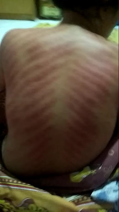 Terapi Pengobatan Masuk Angin