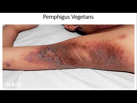 Video: Pemphigus - Uzuri Wa Wadudu
